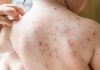 Cayman measles-free but regional cases surge