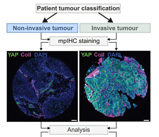 Playing music to cells reduces laryngeal cancer aggressiveness in lab tests