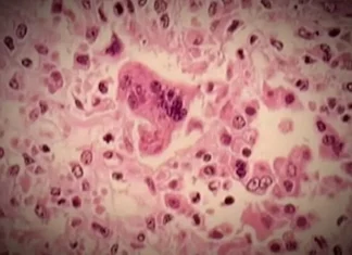 Alberta issues measles exposure alert for Stollery Children’s Hospital