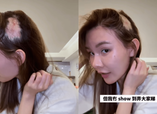 Controversial influencer Rachel Chung reveals severe hair loss, opens up about alopecia