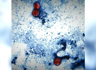 Cyclosporiasis cases rise again. Latest update for Illinois – NBC Chicago