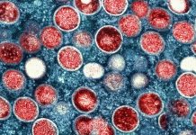 Health officials track Arizona’s first travel-associated case of Clade I mpox